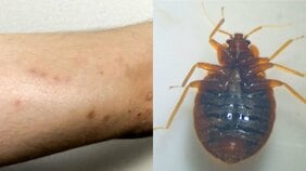 〈日本にもついにトコジラミ⁉〉都内の電車での目撃情報が拡散されパニック…「水際対策はできない」「すでに一般家庭にも侵入」「これからますます繁殖」と専門家…JRにも直撃
