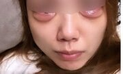 涙袋をつくるためのヒアルロン酸注入で“デメキン”に…「整形がトラウマに」施術女性が涙の訴え 大手美容クリニックの疑問だらけのカウンセリングとアフターケア