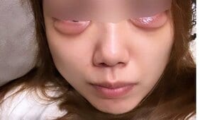 涙袋をつくるためのヒアルロン酸注入で“デメキン”に…「整形がトラウマに」施術女性が涙の訴え 大手美容クリニック”疑問だらけ”のカウンセリングとアフターケア【2024 記事総合 8位】