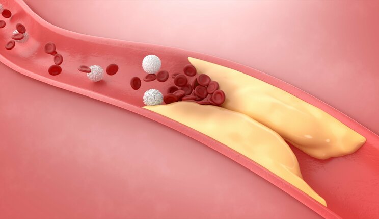 塩分の摂りすぎで高血圧になる、コレステロールは悪者、は本当？ 薬剤師が教える、案外知られていない血圧対策_3