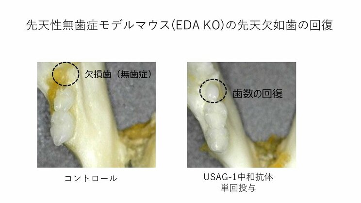 世界初！ 日本で「歯が生える薬」が実現間近！ 入れ歯、インプラントに次ぐ第３の選択肢の実態…死ぬまで自分の歯で食べられる時代がやってくる？_2