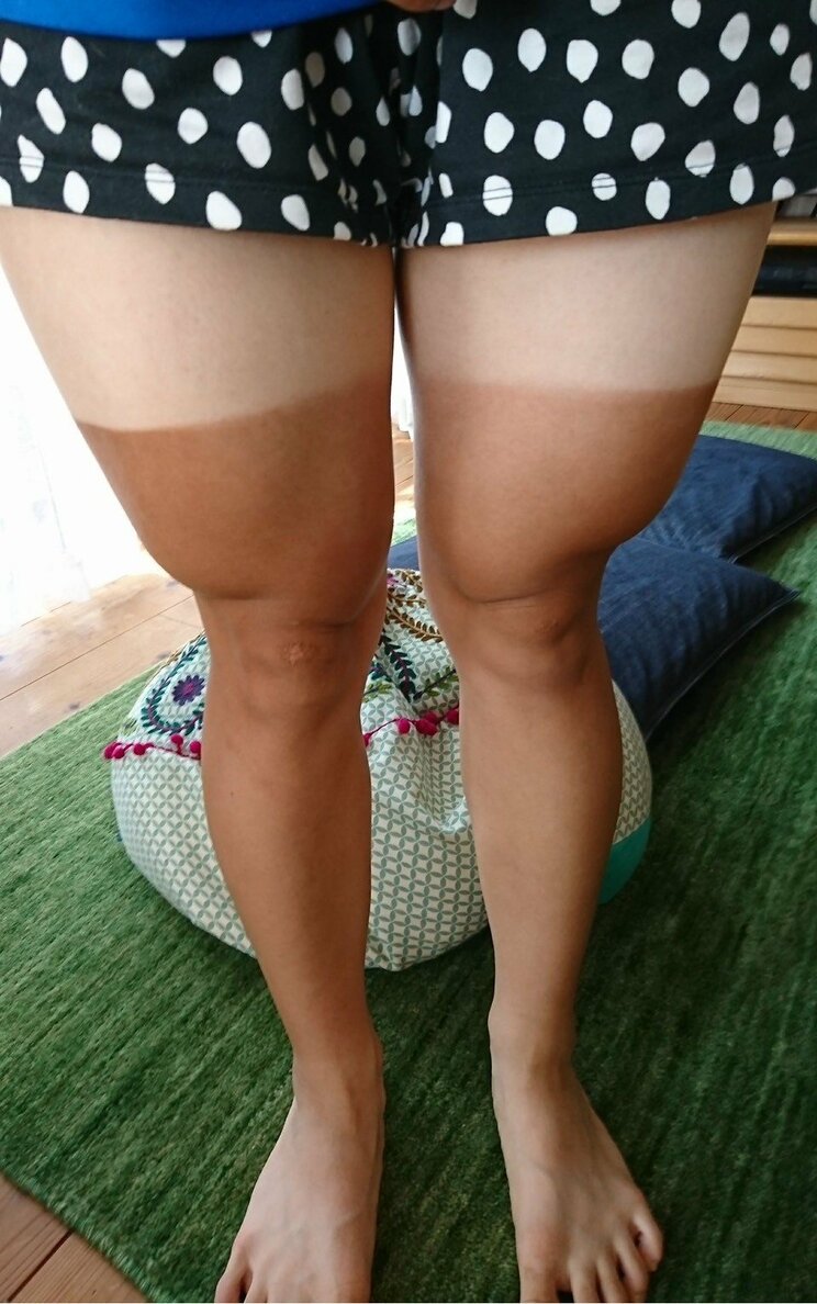 高校時代の日焼けあと（本人提供写真）