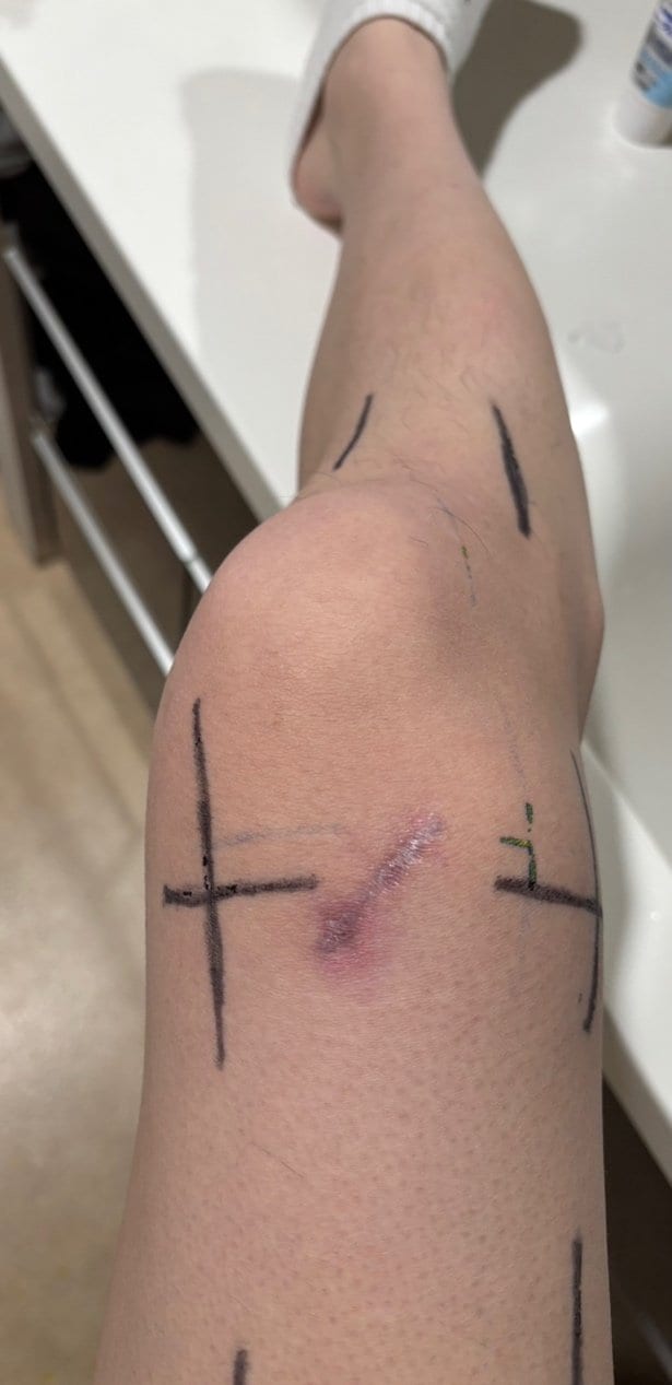 生検の時の傷もまだ残っているひゅうがさんの足（写真／本人提供）