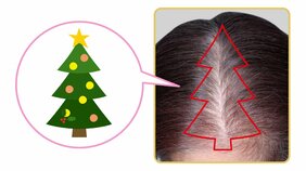 「エスカレーターで先輩女性の薄毛に気づいた」えっ、まさか私も･･･!?　40代ライターが女性の薄毛も目立つことを知った日