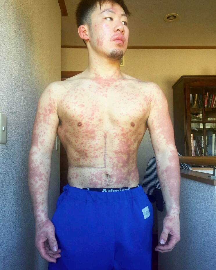 抗がん剤治療の副作用に苦しめられたという