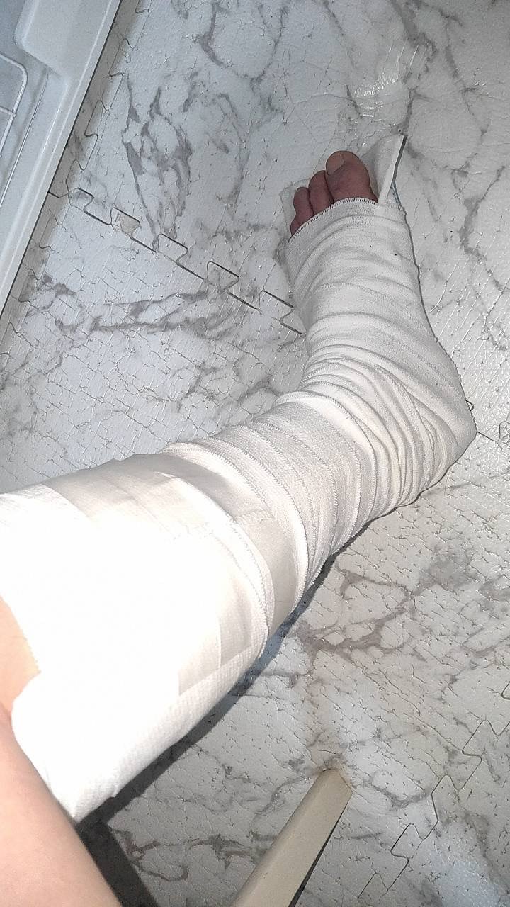 アキレス腱断裂後、ギブスで固定する生活が続いた