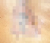Aさんが受けた傷