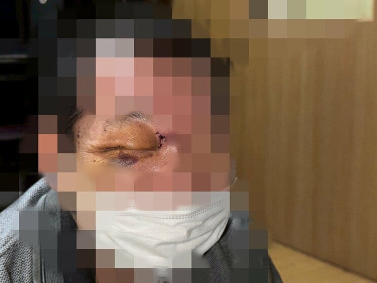 腫れあがったAさんの右目(写真/Aさん提供)