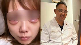 〈涙袋形成のつもりが“デメキン”に〉「適正量の数倍、硬いヒアルロン酸が注入されていた」修正手術を無料で請け負ったクリニック院長が「同じ医師としてありえない」と思うこと