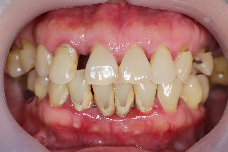大切な歯を失ってしまうかもしれない“ブラキシズム”とは？ 「原因不明の偏頭痛」「犬歯の尖りがなくなった」「歯の付け根にくぼみ」の兆候には要注意_4