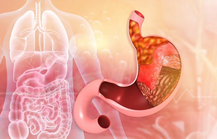 胃には「顔つき」がある…3000件以上の胃を肉眼で見てきた医師か語る、胃がんになる人となりにくい人の決定的な差_2