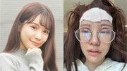 「最も高額だったのはアゴで437万円」整形総額2400万円の人気インフルエンサーが明かす最もしんどかった3つの手術「血を吐き続け、息もしづらくて…」