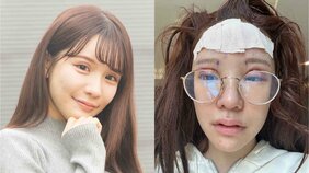 「最も高額だったのはアゴで437万円」整形総額2400万円の人気インフルエンサーが明かす最もしんどかった3つの手術「血を吐き続け、息もしづらくて…」