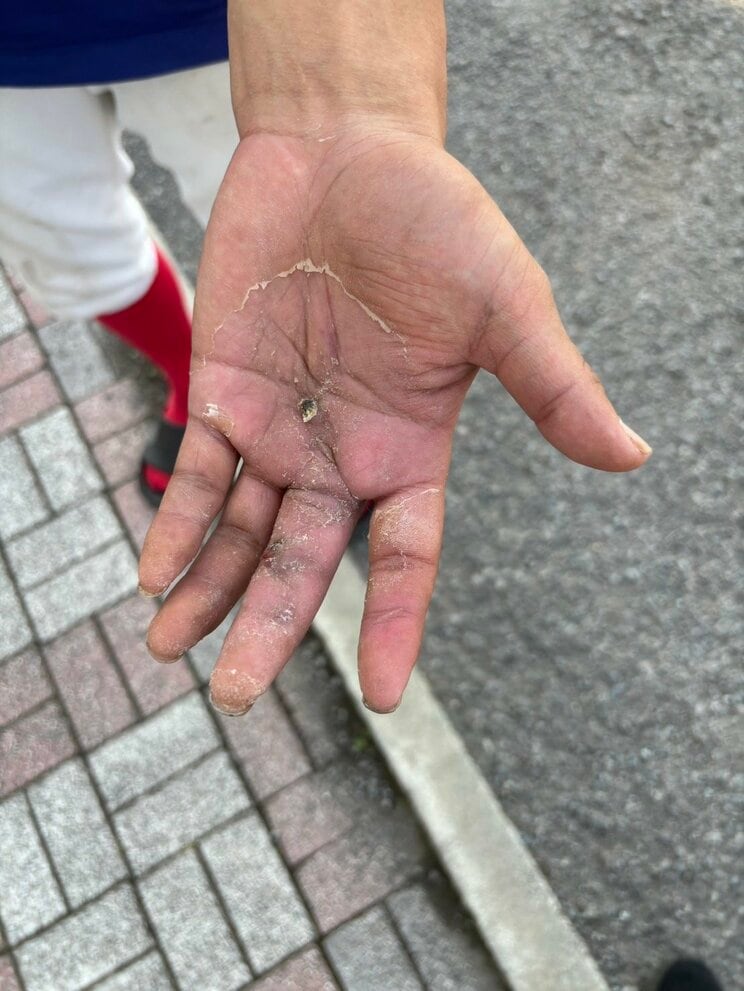 滝野氏の手、傷跡が痛々しかった（撮影／集英社オンライン）