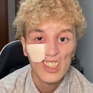 希少がんと闘うもりひさん、顔には大きなガーゼを貼ってライブ配信をしている（画像／本人のSNSより引用）