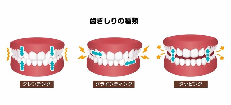 大切な歯を失ってしまうかもしれない“ブラキシズム”とは？ 「原因不明の偏頭痛」「犬歯の尖りがなくなった」「歯の付け根にくぼみ」の兆候には要注意_1
