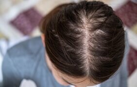 「エスカレーターで先輩女性の薄毛に気づいた」えっ、まさか私も・・・!? 40代ライターが女性の薄毛も目立つことを知った日