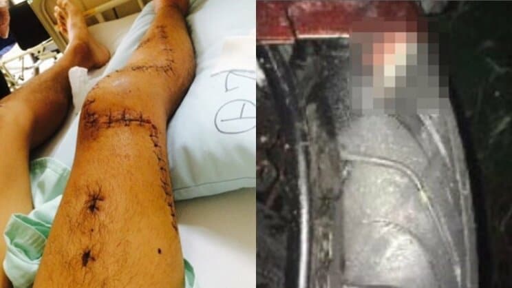 80針縫った足と、タイヤに突き刺さったグリ長の骨