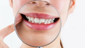 口を閉じているとき、無意識に奥歯が当たっていませんか? 歯の天敵「TCH」の噛みグセが歯を失うリスクを増大させている!
