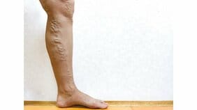 それって下肢静脈瘤かも!? 足がつる、だるい、かゆい…専門医が唱える9つのセルフチェック&簡単だけど効果絶大の対策