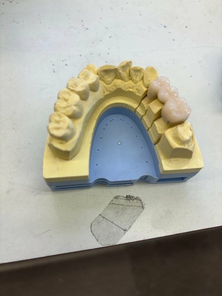歯科技工士がつくった歯が入らなくなる？