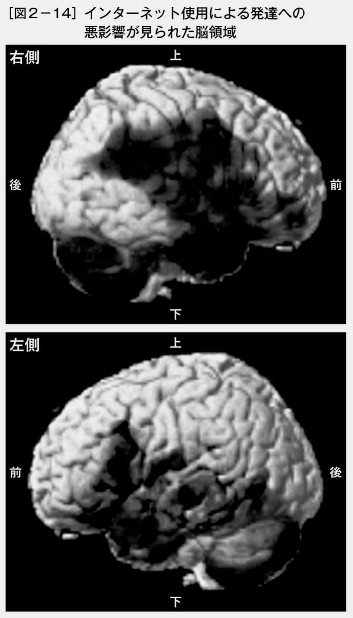 ネットを毎日使い続けた子どもの3年後の脳画像が衝撃…認知機能、記憶や学習に関わる海馬のほか、言葉や感情を処理する領域が真っ黒に_2