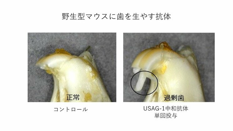 世界初！ 日本で「歯が生える薬」が実現間近！ 入れ歯、インプラントに次ぐ第３の選択肢の実態…死ぬまで自分の歯で食べられる時代がやってくる？_3