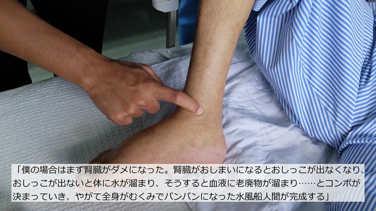 酒飲みながらゲーム配信してたら“膵臓が爆発”でICU行き、全身パンパンの水風船と化した自分に「マジで死ぬよ」と医師が宣告_7