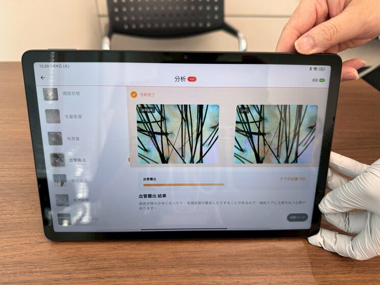 頭皮チェックでは、脱毛類型や頭皮状態、毛髪密度、角質量、血管露出、毛穴状態、毛の太さを分析してくれた