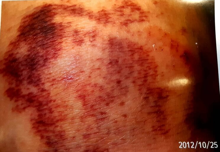 暴行により、膝に残ったあざ（写真／家族提供）