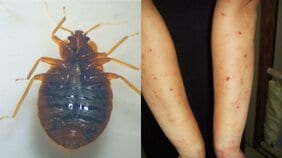 〈トコジラミが日本でも猛威!?〉驚異的な繁殖力で市販殺虫剤も効かず、駆除費用は高額。フランスでは10世帯に1世帯以上が被害で、休校も相次ぎ…