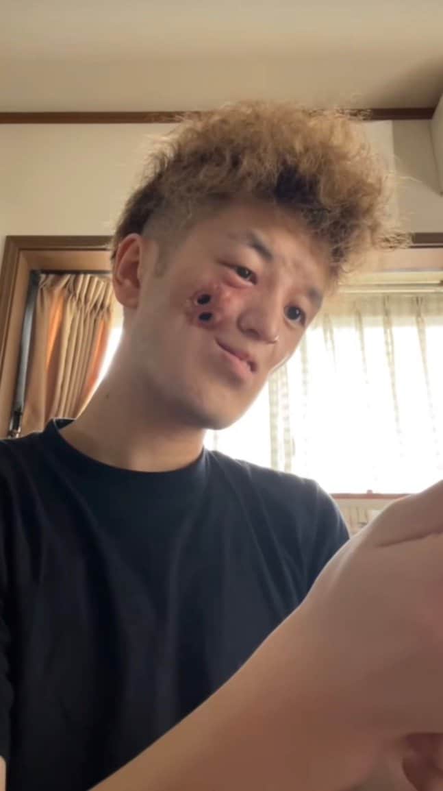 動画を投稿し始めた頃の顔の穴（画像／本人のSNSより引用）