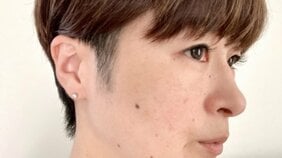 左右非対称、色に濃淡、直径6㎜以上…ほくろに現れる皮膚がんのサイン
